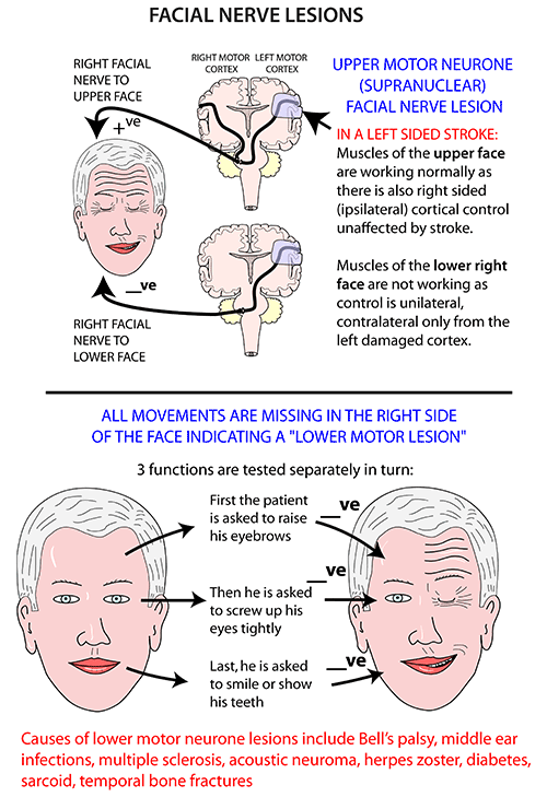 Facial Nerve Lesion 13